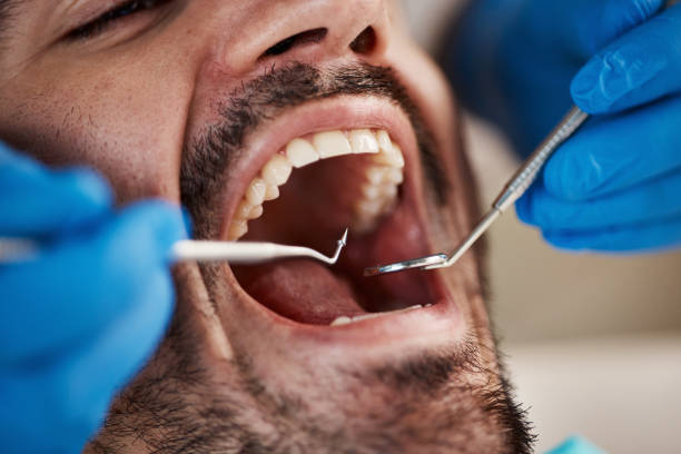 Best Emergency Dental Extractions in Atlanta, GA